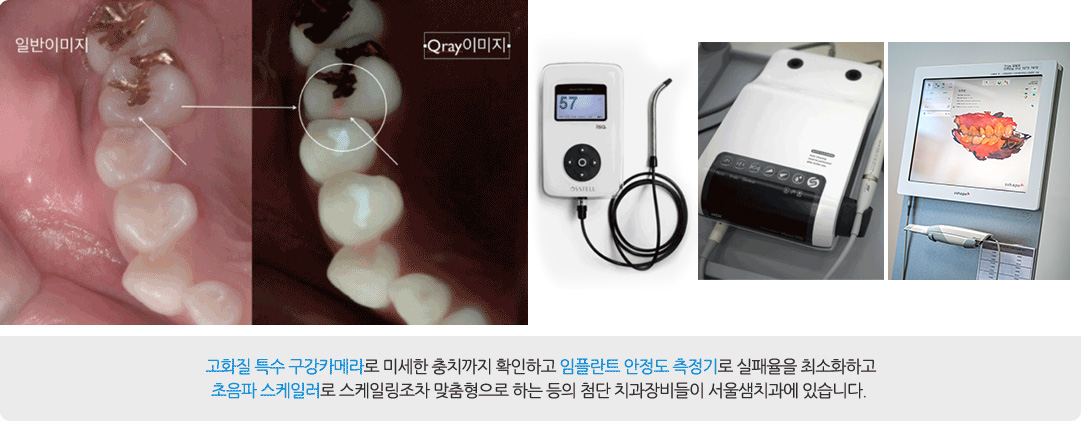 고화질 특수 구강카메라로 미세한 충치까지 확인하고 임플란트 안정도 측정기로 실패율을 최소화하고 초음파 스케일러로 스케일링조차 맞춤형으로 하는 등의 첨단 치과장비들이 서울샘치과에 있습니다.