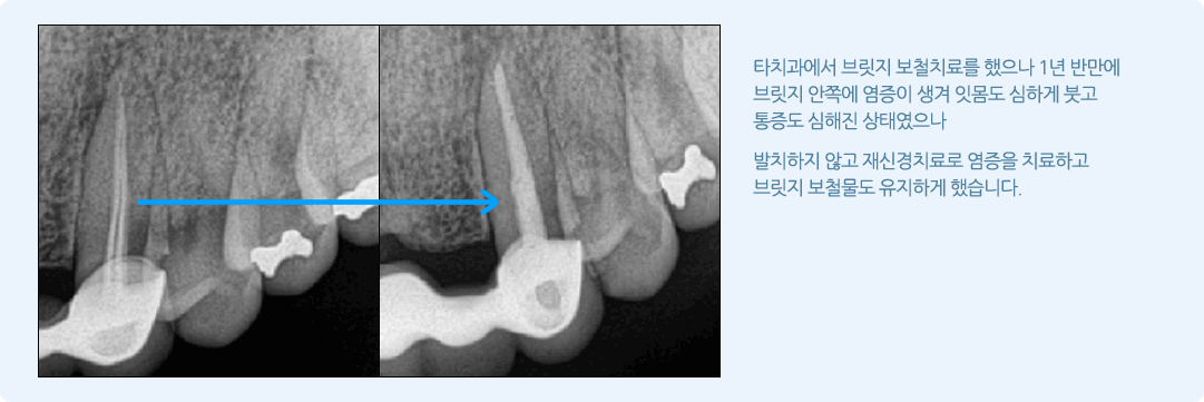 서울샘의 임플란트?