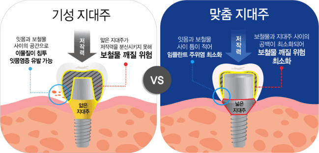 서울샘의 임플란트?