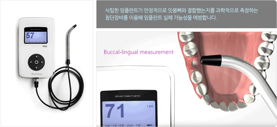 서울샘의 임플란트?