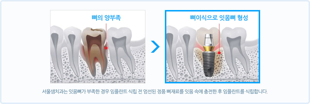 뼈이식 임플란트