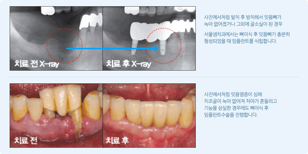 뼈이식 임플란트