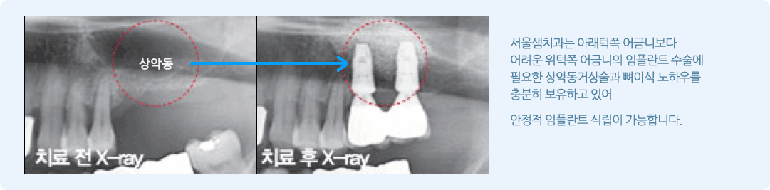상악동 임플란트