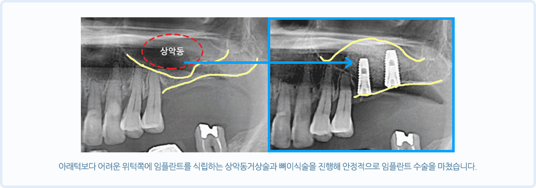 상악동 임플란트