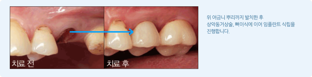 상악동 임플란트