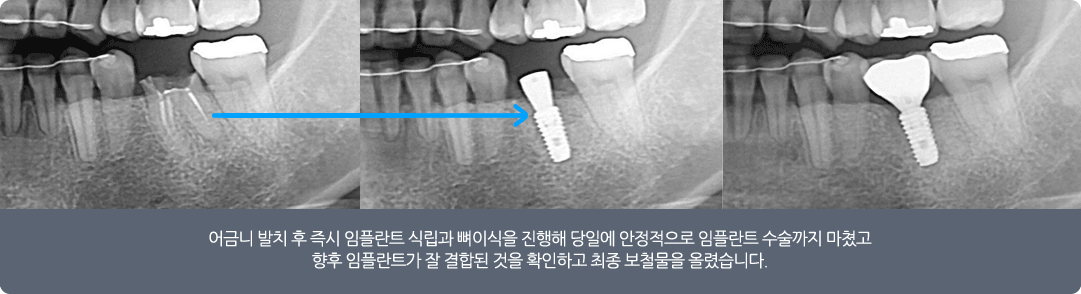 당일 식립 임플란트