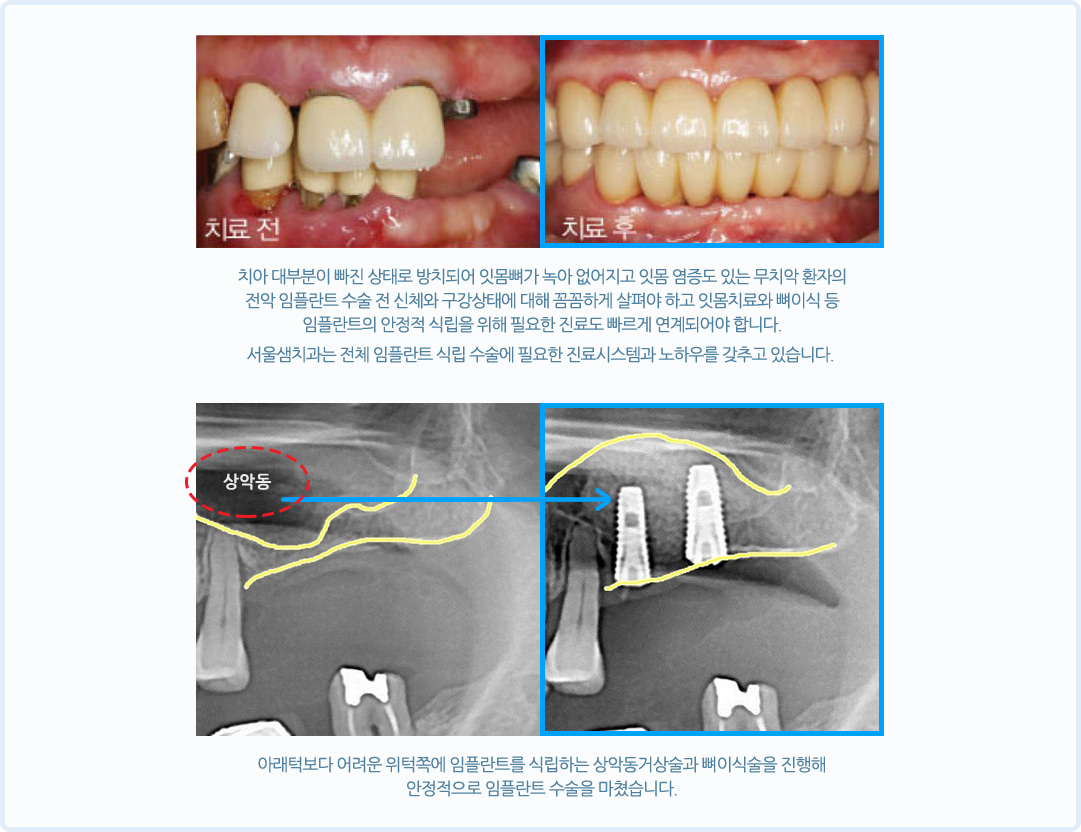 전체 임플란트