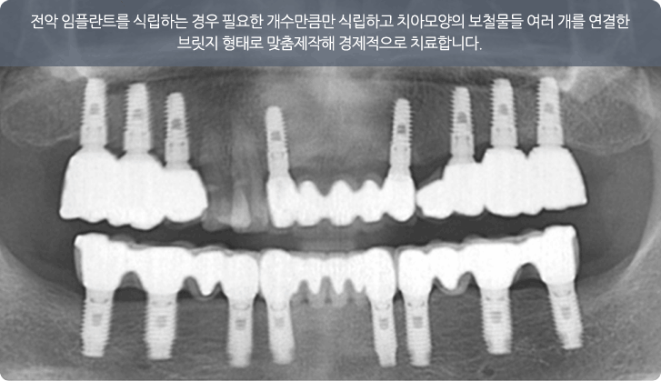 전체 임플란트