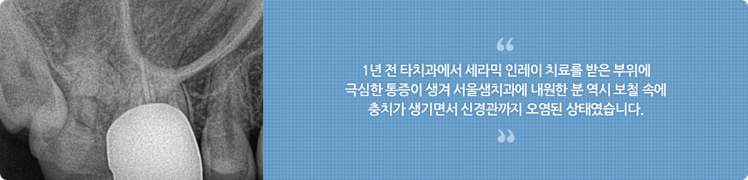 신경치료/재치료