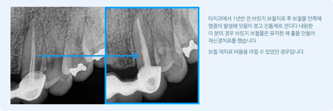 신경치료/재치료